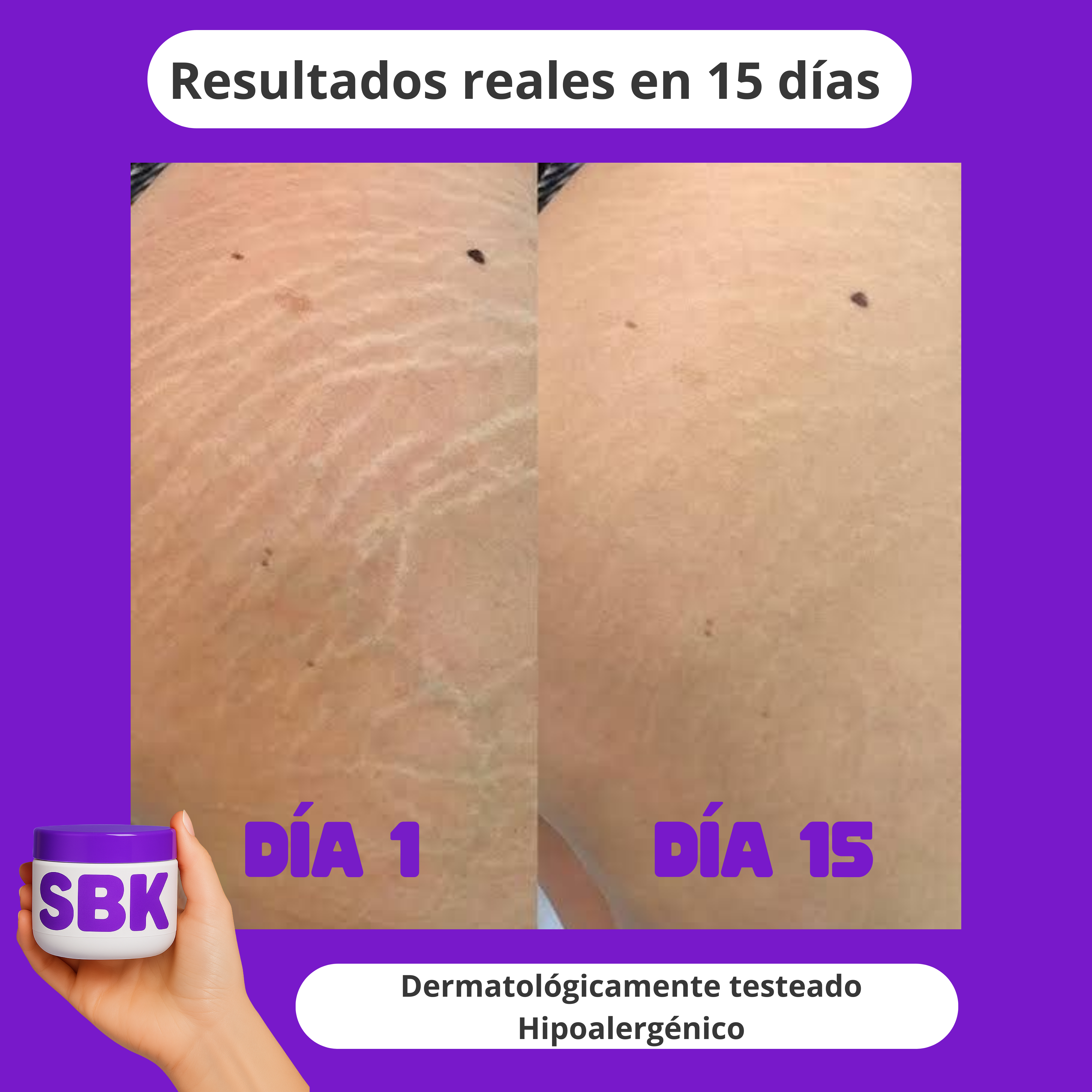 Crema Anti-Estrías Reafirmante SBK 200ml ✨ 🧴 Con Rosa Mosqueta, Centella Asiática y Ácido Hialurónico