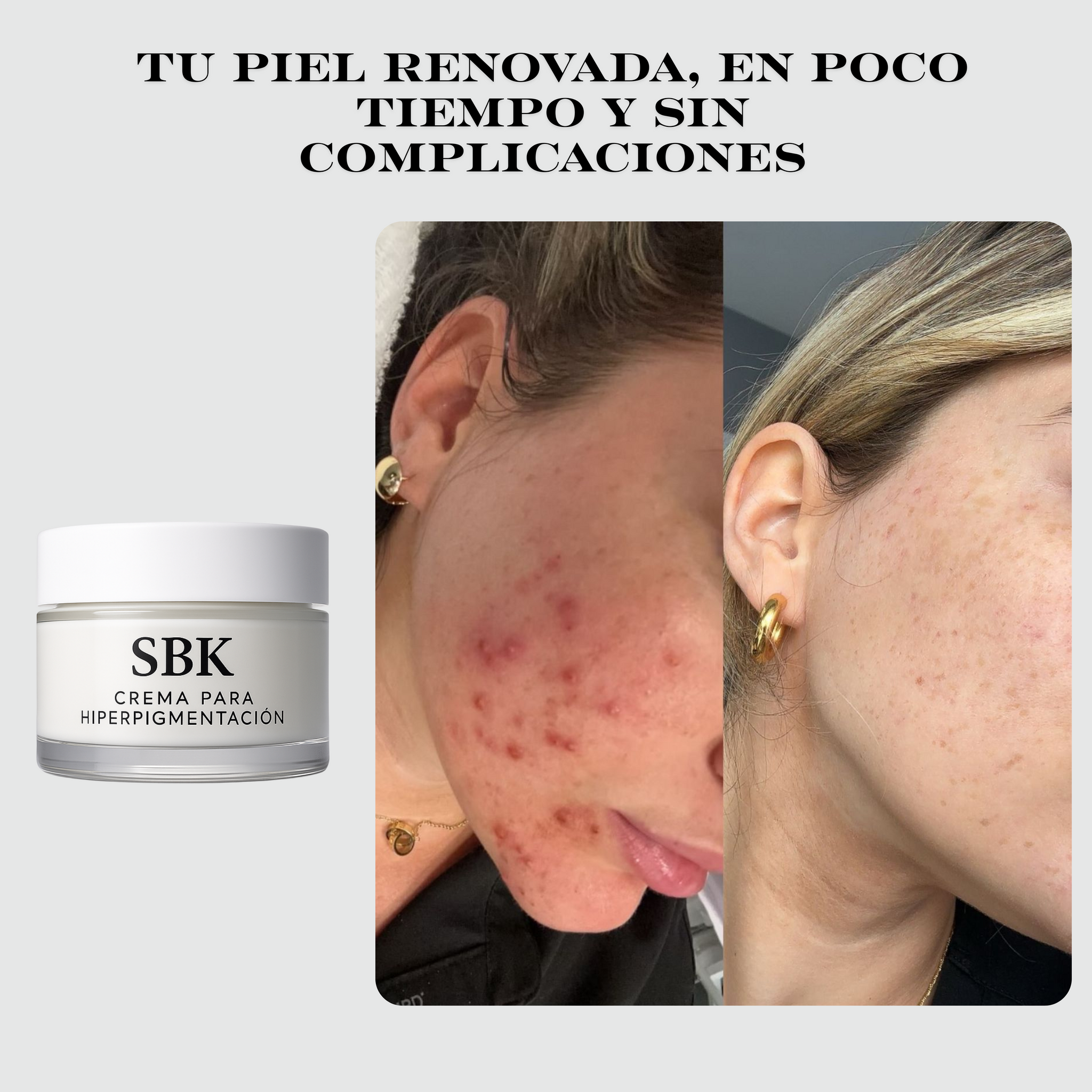 SBK Crema Despigmentante 🌸 elimina manchas y unifica el tono